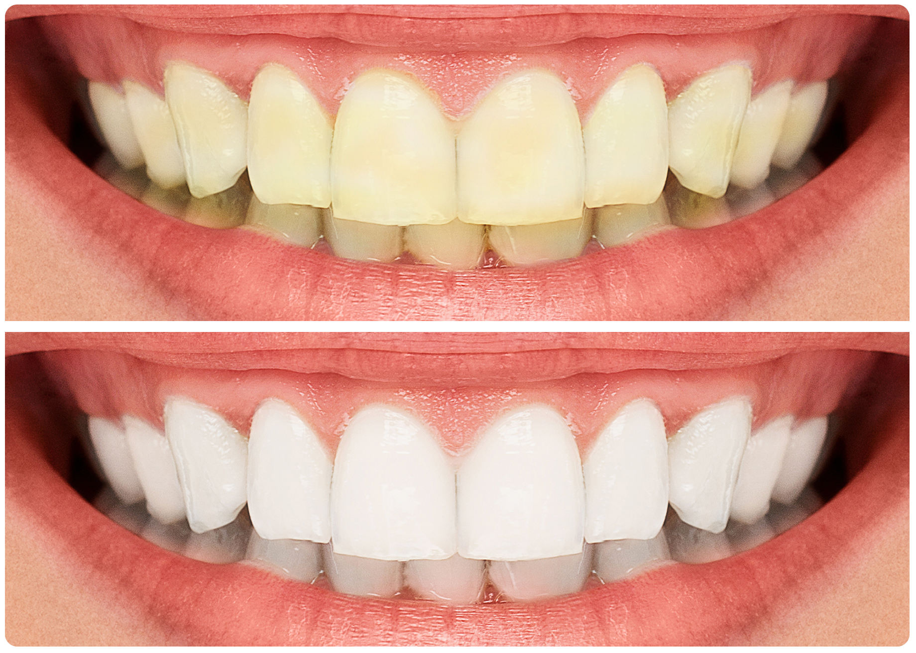 Unveiling the Science Behind Teeth Whitening!